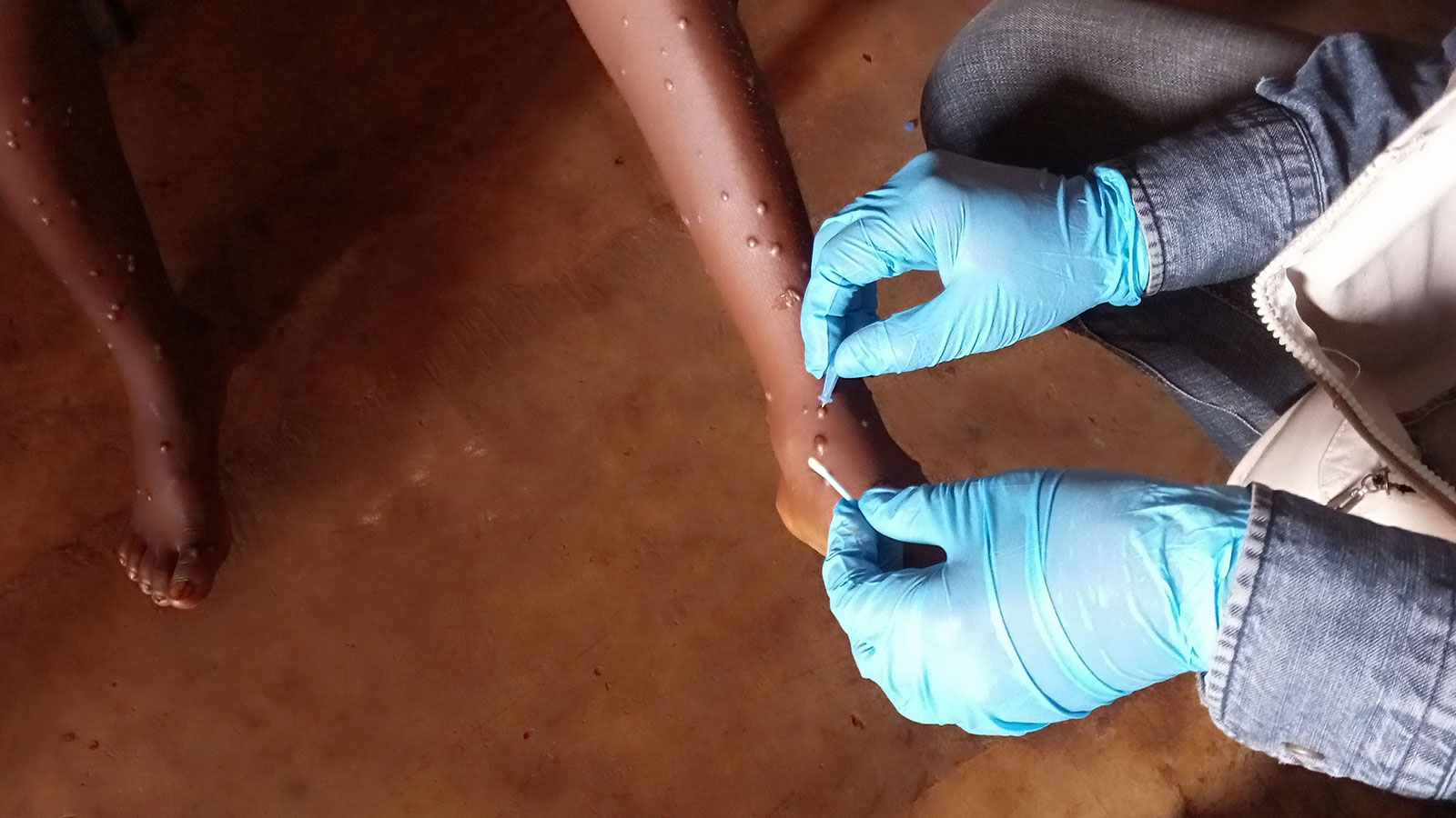 Déclaration critique de l'Union européenne après l'alarme concernant le virus de la variole du singe