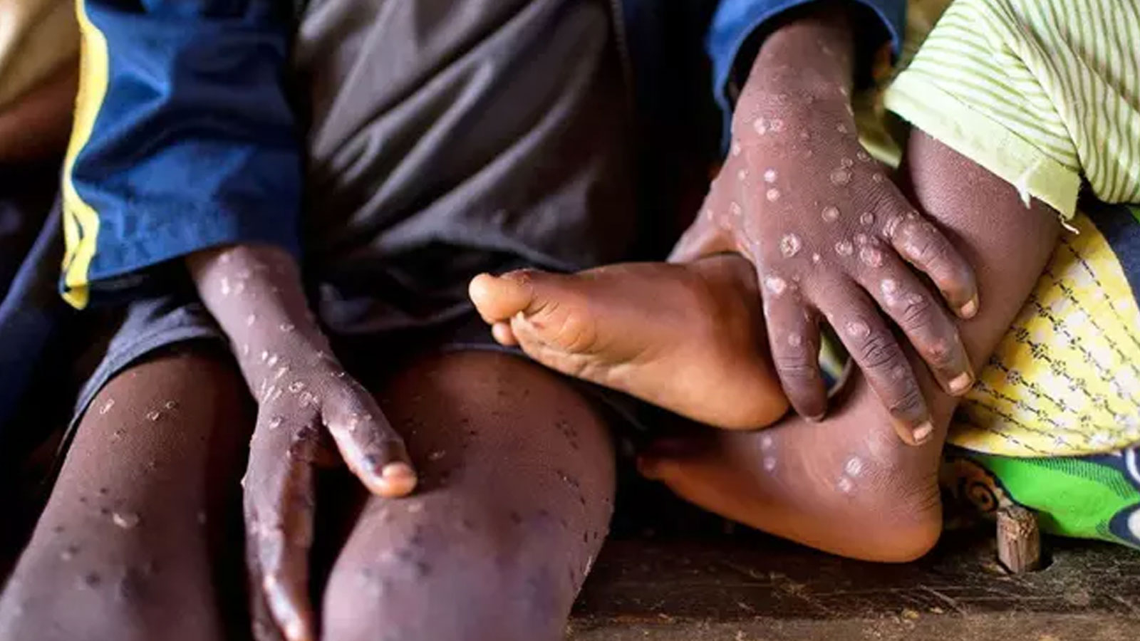 Le monde est menacé par le virus de la variole du singe ! Le nombre de cas et de décès augmente