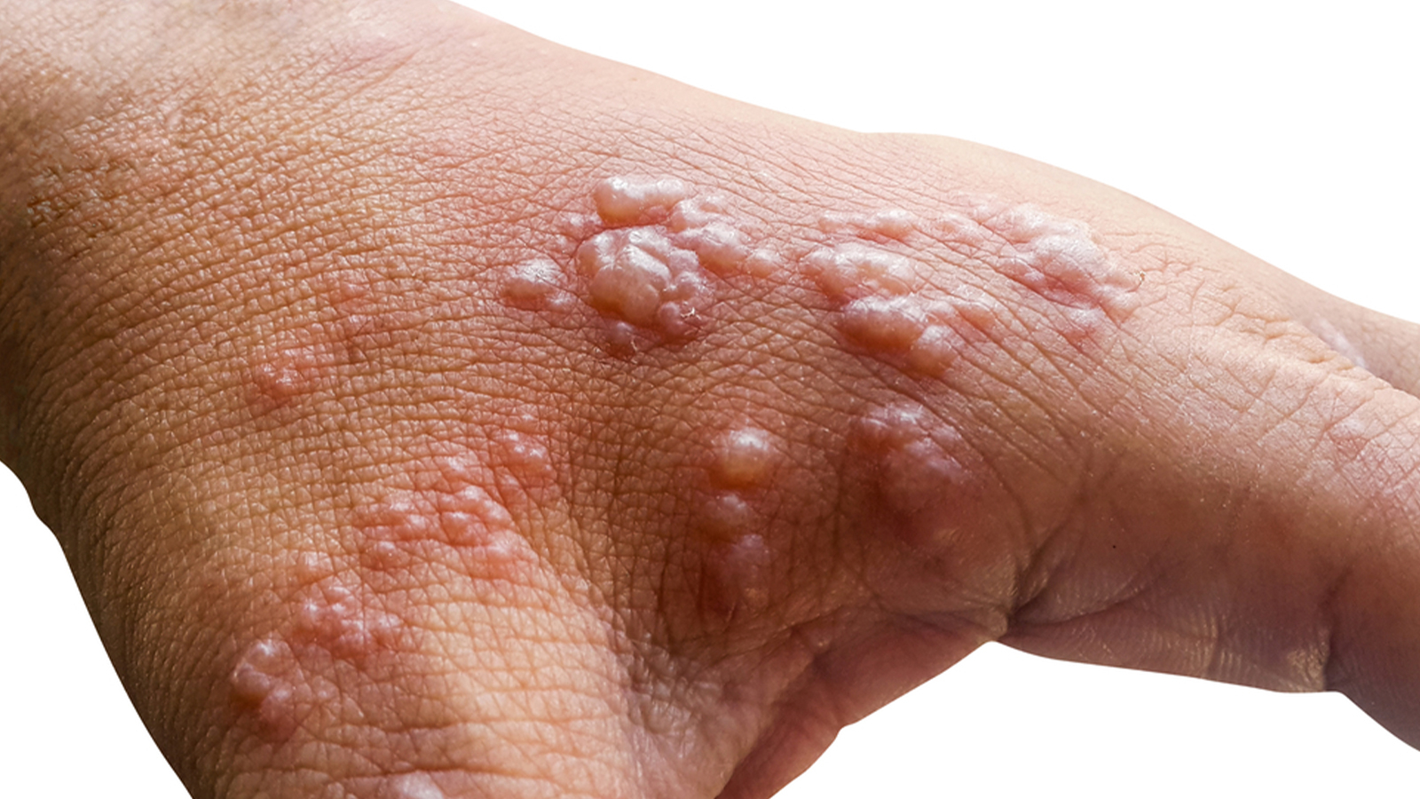 Sommes-nous victimes de stress? L'augmentation de la zone