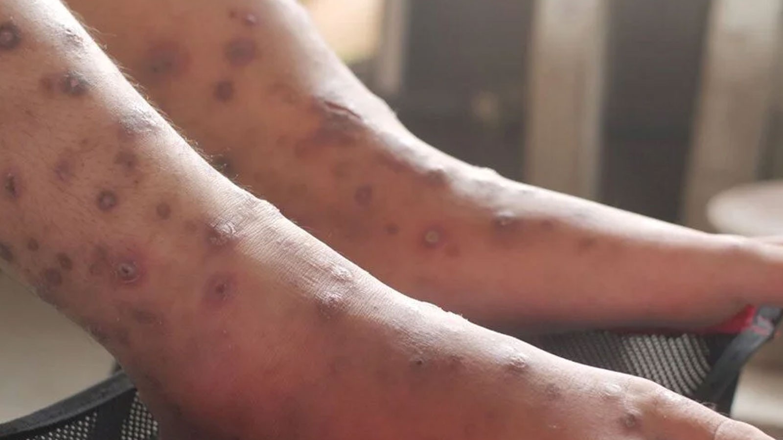 Ni le coronavirus ni le cancer! Le monde est dans la griffe d'une nouvelle maladie mortelle! C'est une question de temps pour se propager