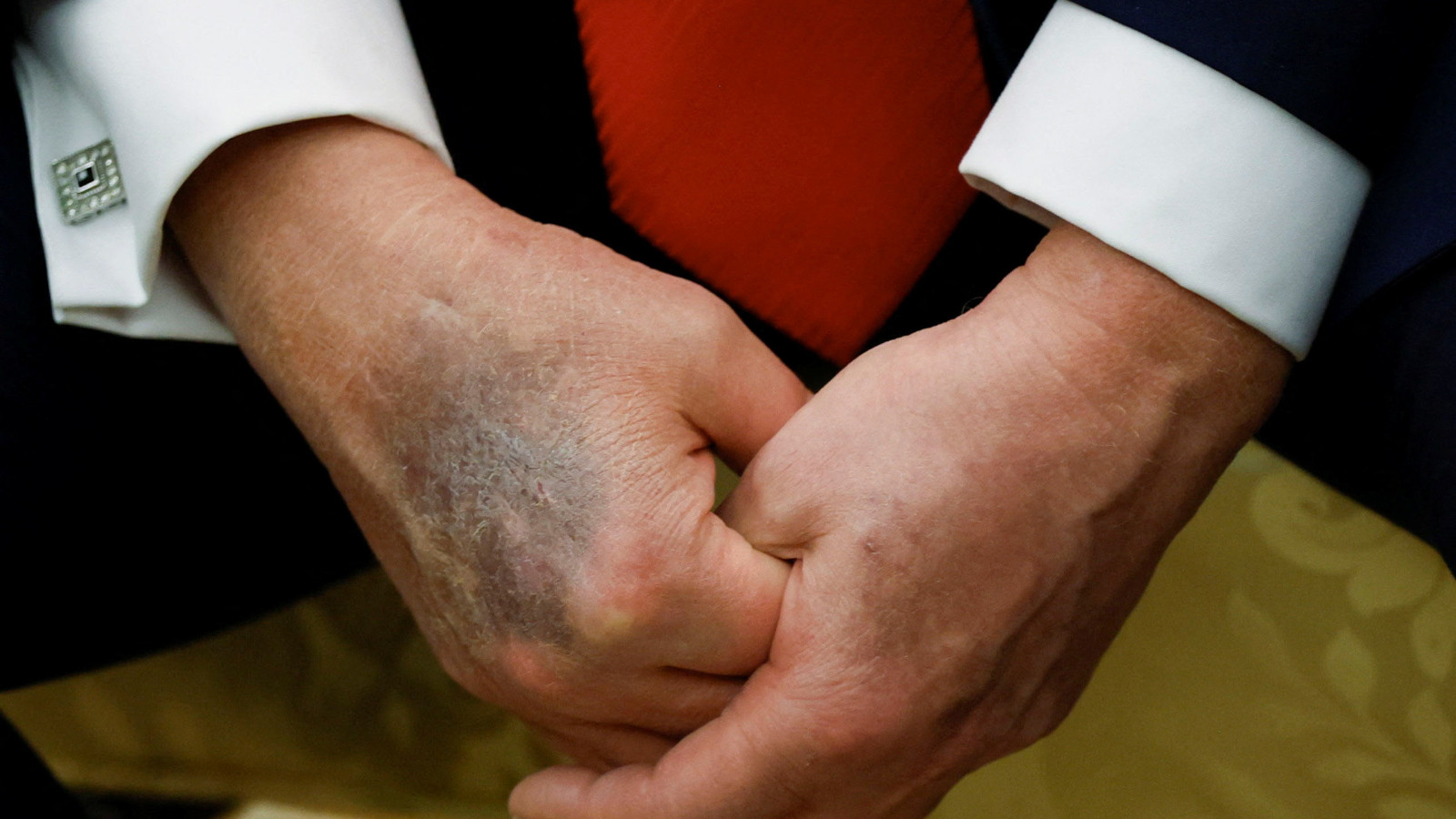 Qu'est-il arrivé à Donald Trump? Mains meurtries, yeux gonflés, bouche tombante et difficulté de marche