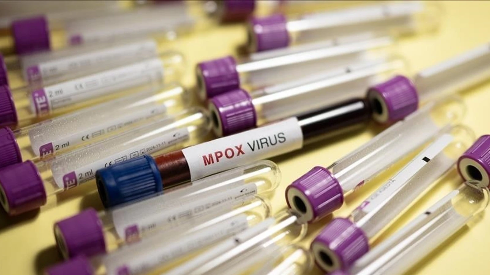 L'épidémie de M-pox augmente : le nombre de cas dans le pays a dépassé les 2 000
