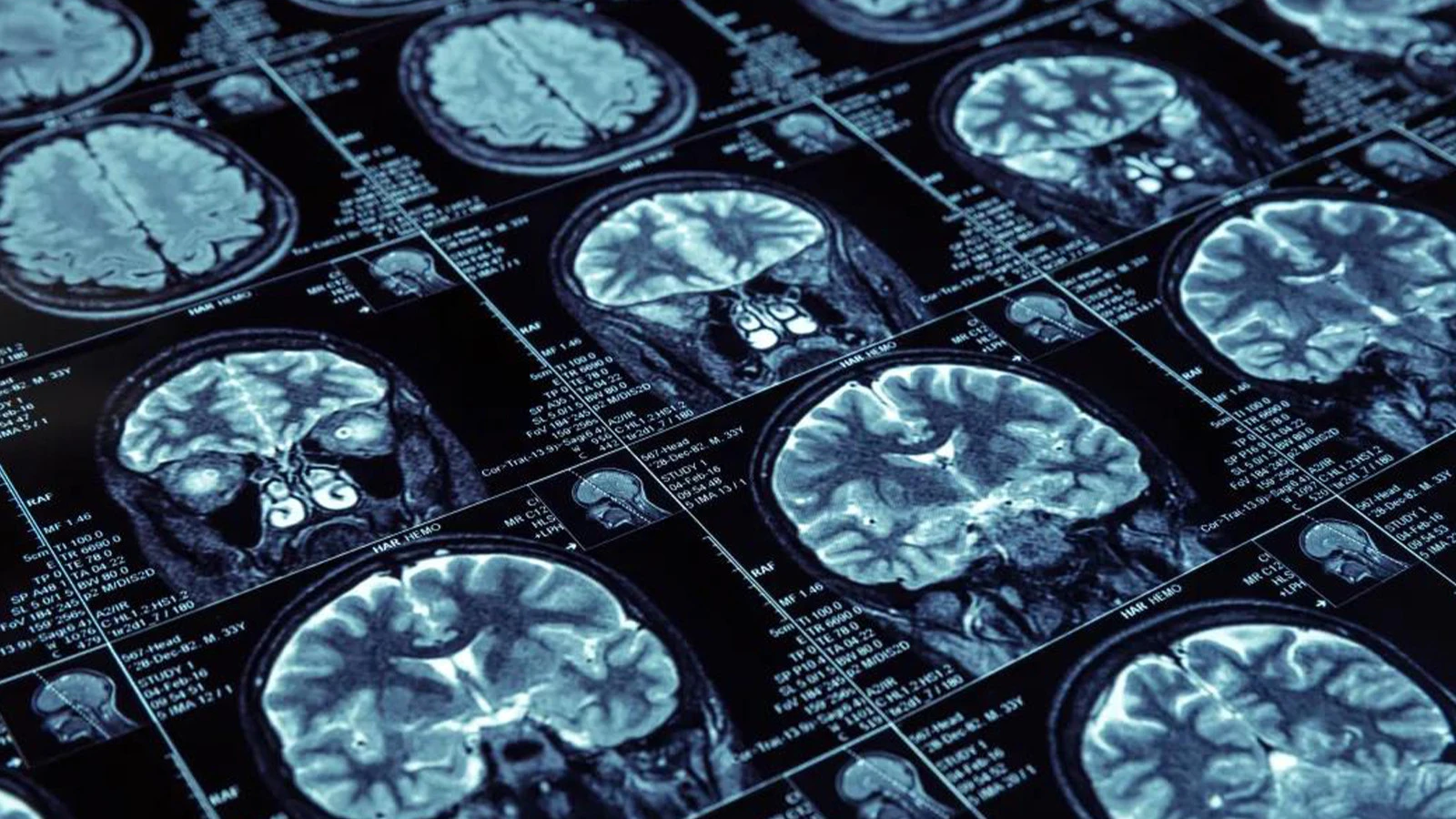 Recherche « Démence » aux USA : Ces 3 habitudes peuvent retarder la maladie de 13 ans